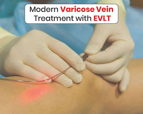 EVLT for Varicose Veins
