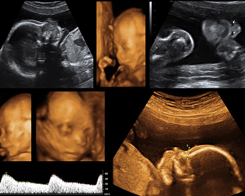 3D/4D Pelvic Scans