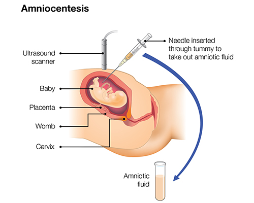 Amniocentesis & CVS Test